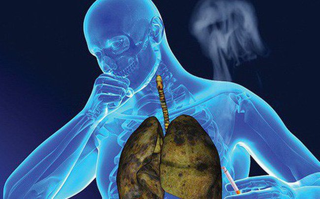 Công dụng của nấm linh chi đối với bệnh ung thư phổi 3